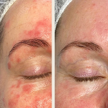 Behandling af Rosacea