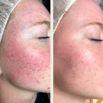 Behandling af Rosacea
