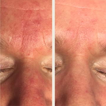 Behandling af Rosacea