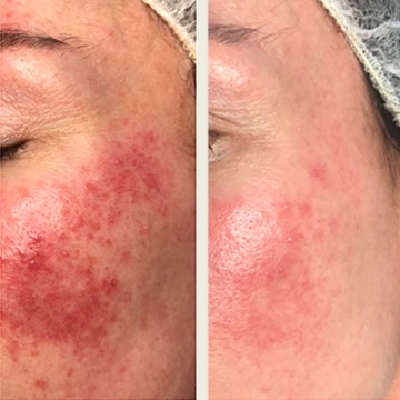 Behandling af Rosacea