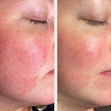 Behandling af Rosacea