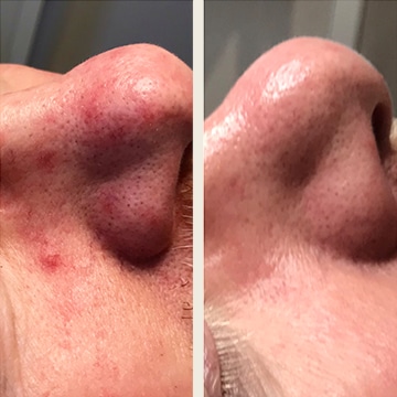 Behandling af Rosacea