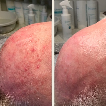 Behandling af Rosacea