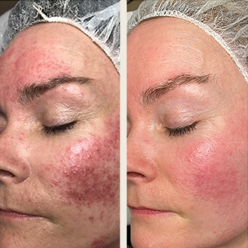 Behandling af Rosacea
