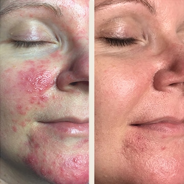 Behandling af Rosacea