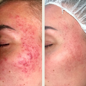 Behandling af Rosacea