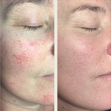 Behandling af Rosacea