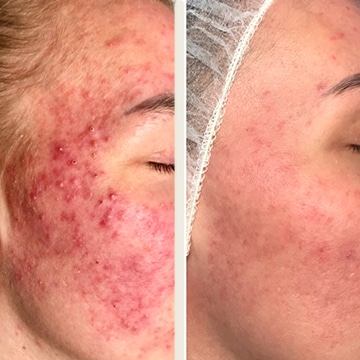 Behandling af Rosacea