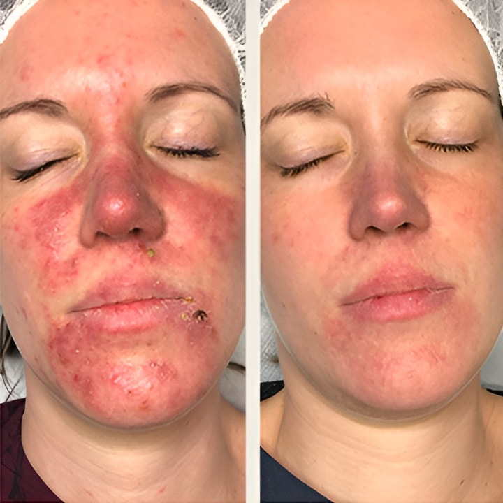 Behandling af Rosacea