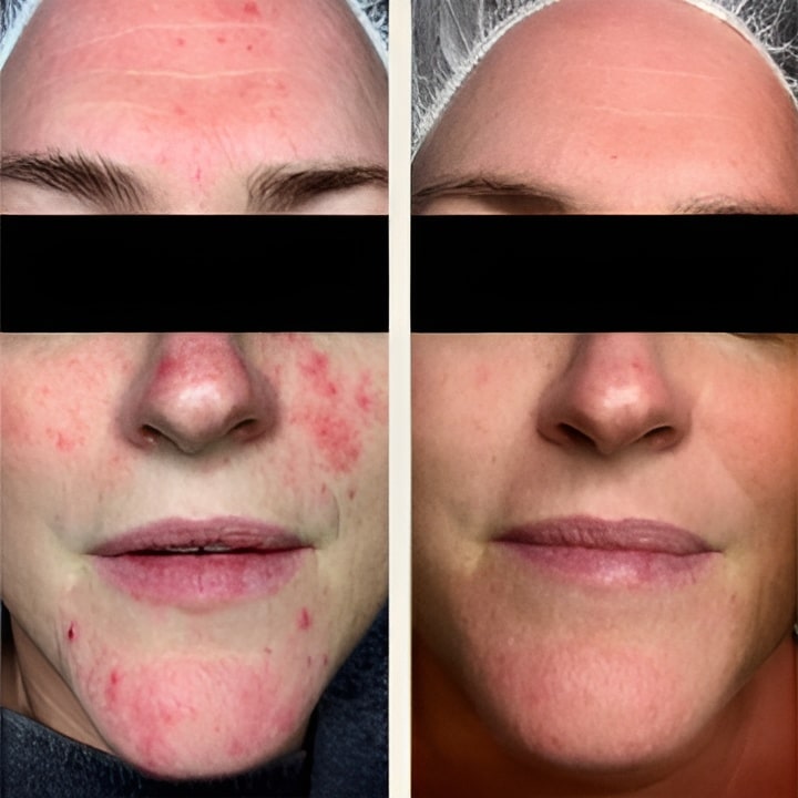 Behandling af Rosacea