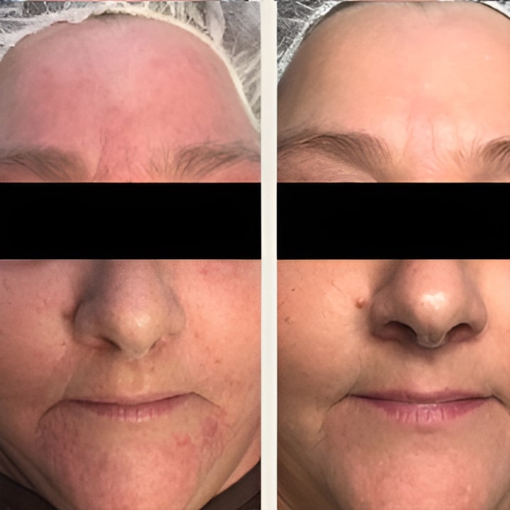 Behandling af Rosacea