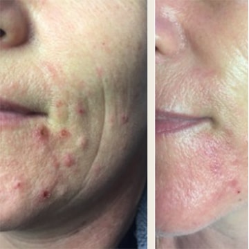 Behandling af Rosacea
