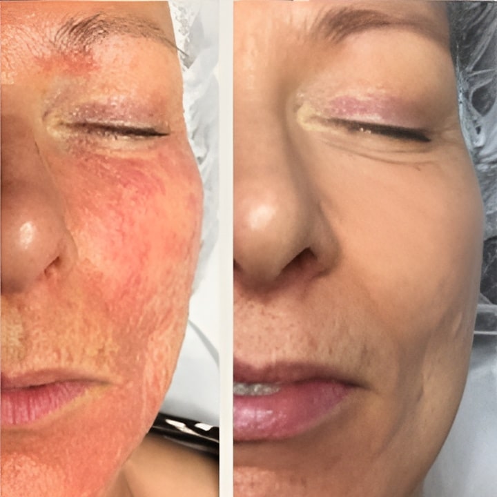 Behandling af Rosacea