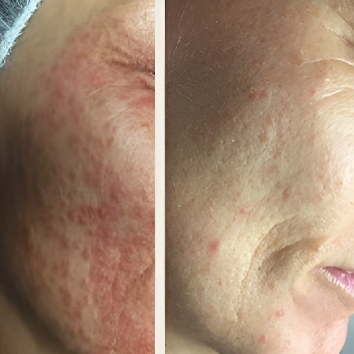 Behandling af Rosacea