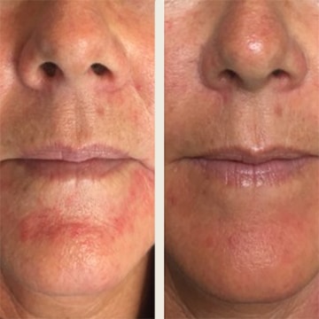 Behandling af Rosacea