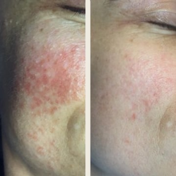 Behandling af Rosacea