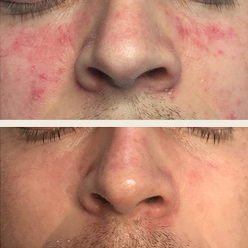 Behandling af Rosacea