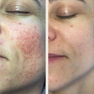 Behandling af Rosacea