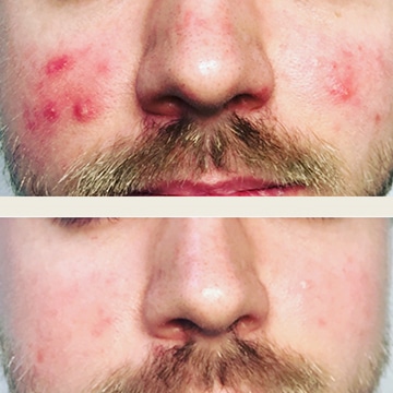 Behandling af Rosacea