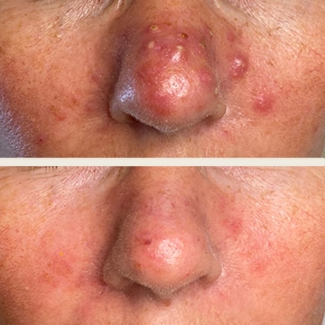 Behandling af Rosacea
