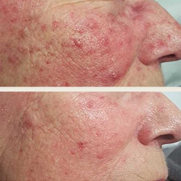 Behandling af Rosacea