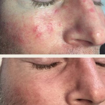 Behandling af Rosacea