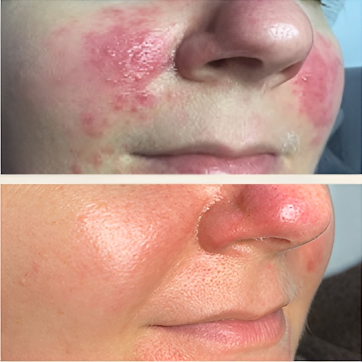 Behandling af Rosacea