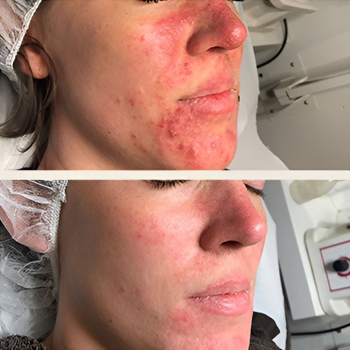 Behandling af Rosacea