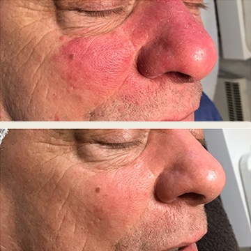 Behandling af Rosacea