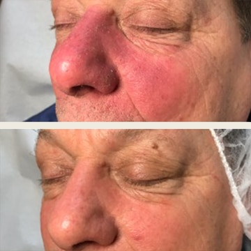 Behandling af Rosacea