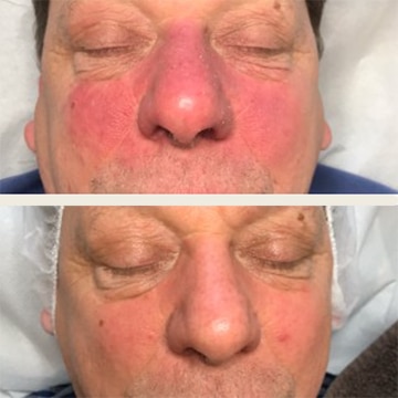 Behandling af Rosacea