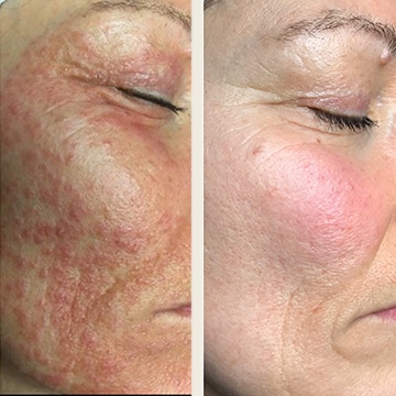 Behandling af Rosacea
