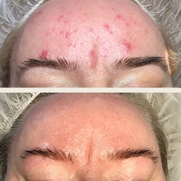 Behandling af Rosacea