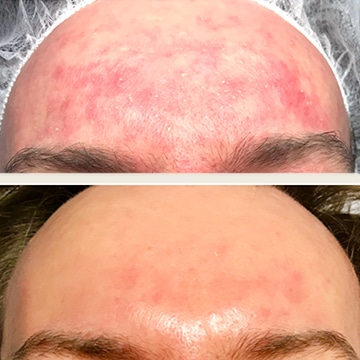 Behandling af Rosacea