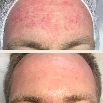 Behandling af Rosacea