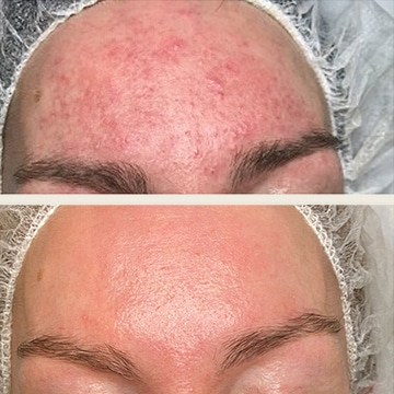 Behandling af Rosacea