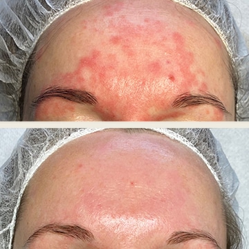 Behandling af Rosacea