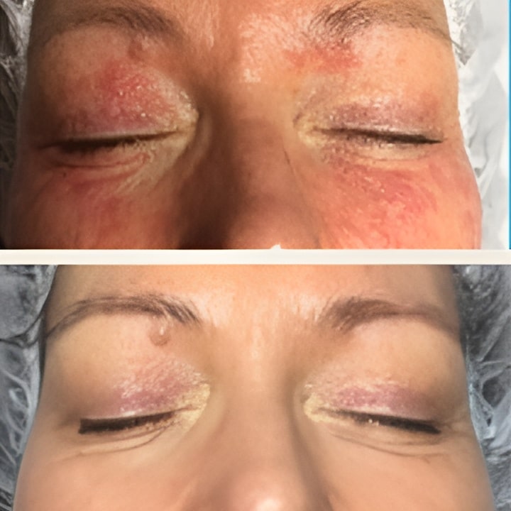 Behandling af Rosacea