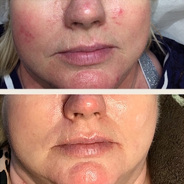 Behandling af Rosacea