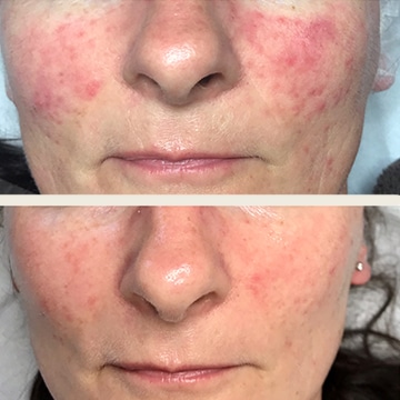 Behandling af Rosacea