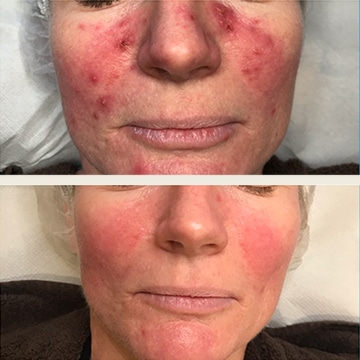 Behandling af Rosacea