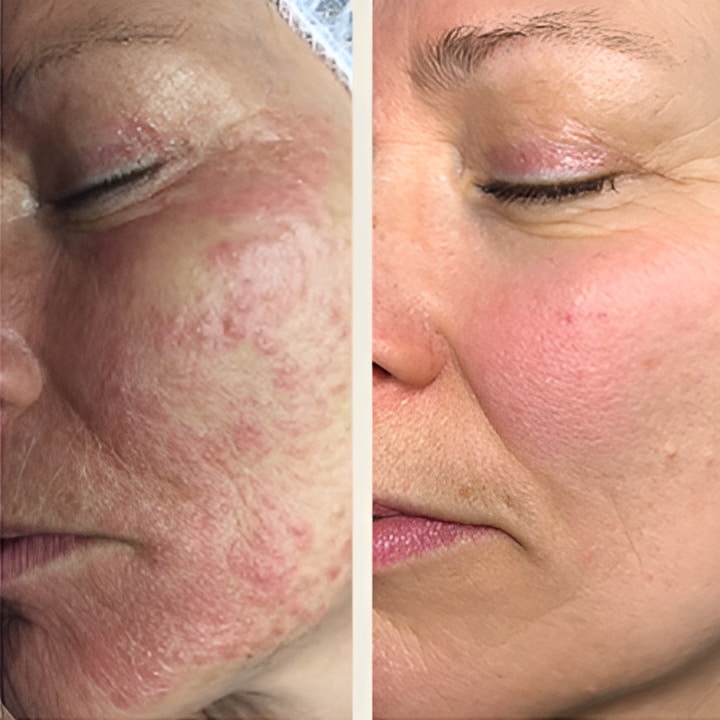 Behandling af Rosacea