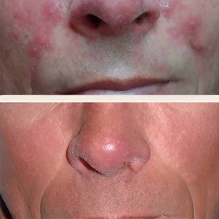 Behandling af Rosacea