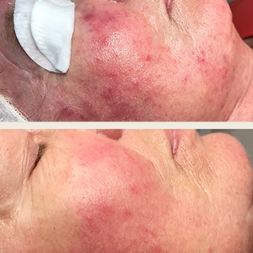 Behandling af Rosacea