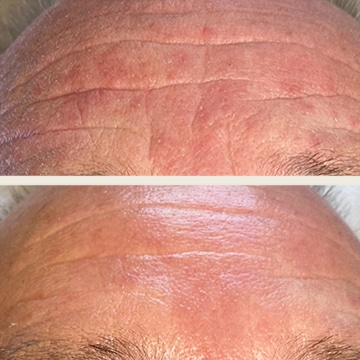Behandling af Rosacea