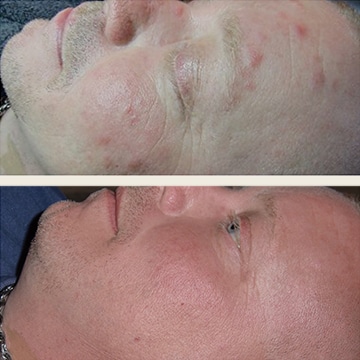 Behandling af Rosacea