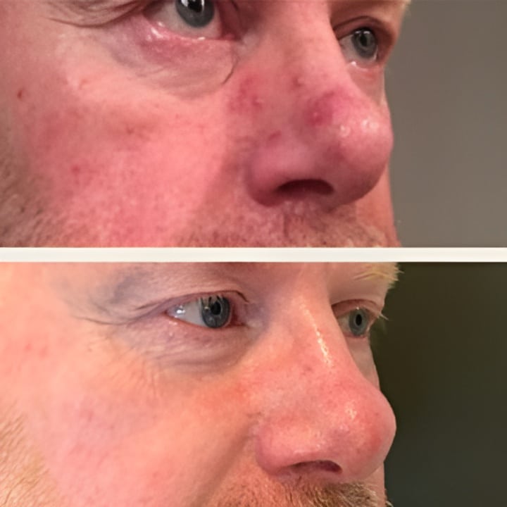 Behandling af Rosacea