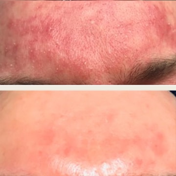 Behandling af Rosacea