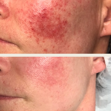 Behandling af Rosacea