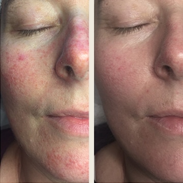Behandling af Rosacea